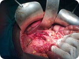 Surgery CA Pancreas 2